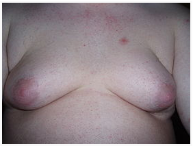 gynecomastia