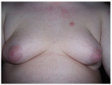 What is Gynecomastia?